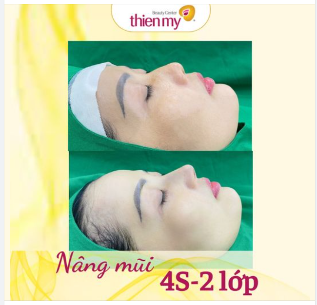 Ưu điểm khi nâng mũi tại Thiện Mỹ: