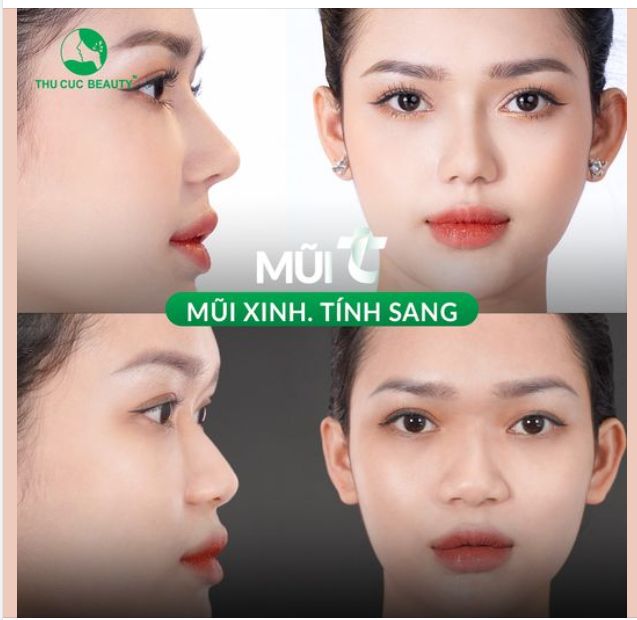 Mũi TC. Đẹp ngay sau làm. Không đau. Không sẹo. Không lộ sụn