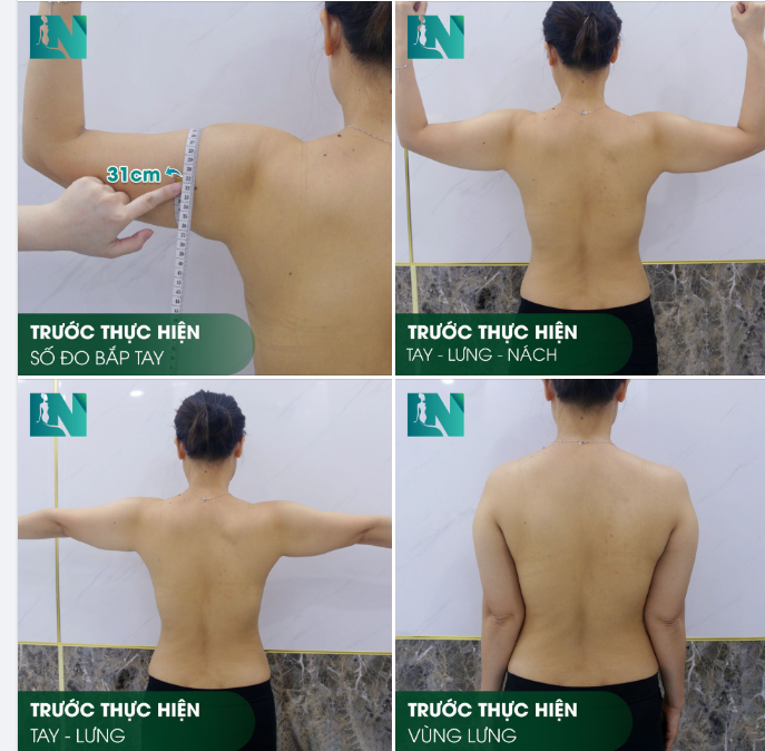 SỐ ĐO BẮP TAY 31CM SẼ GIẢM CÒN BAO NHIÊU SAU KHI THỰC HIỆN HÚT MỠ TAY - LƯNG - NÁCH?