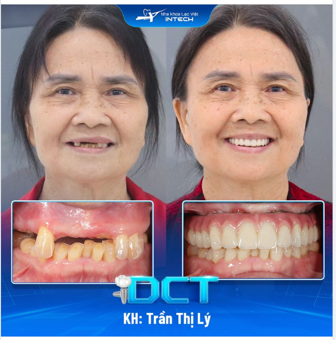 CÔNG NGHỆ TRỒNG RĂNG DCT CÓ THỂ KHÔI PHỤC 95% THẨM MỸ VÀ KHẢ NĂNG ĂN NHAI - THỰC TẾ HAY LÀ PHI LÝ?