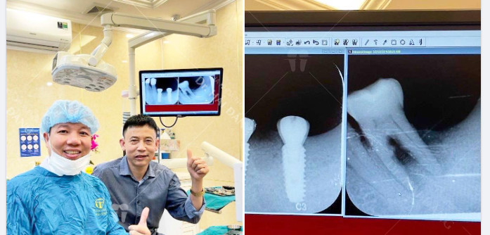 TRỒNG RĂNG IMPLANT- PHỤC HÌNH ĂN NHAI