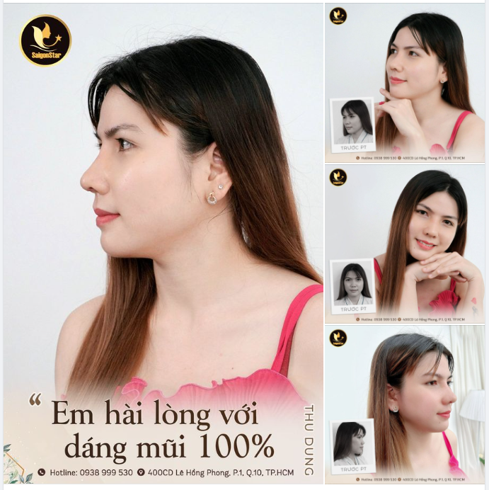  Chị Thu Dung (Việt kiều Đài Loan) chia sẻ. Phương pháp nâng mũi cấu trúc Dr. Hoạt giúp khách hàng: