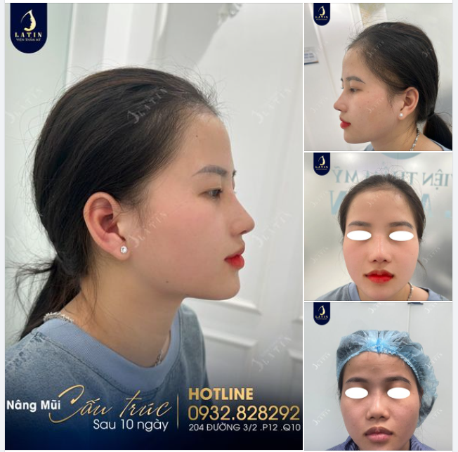 10 ngày lên form mũi mới đẹp tự nhiên cho em gái