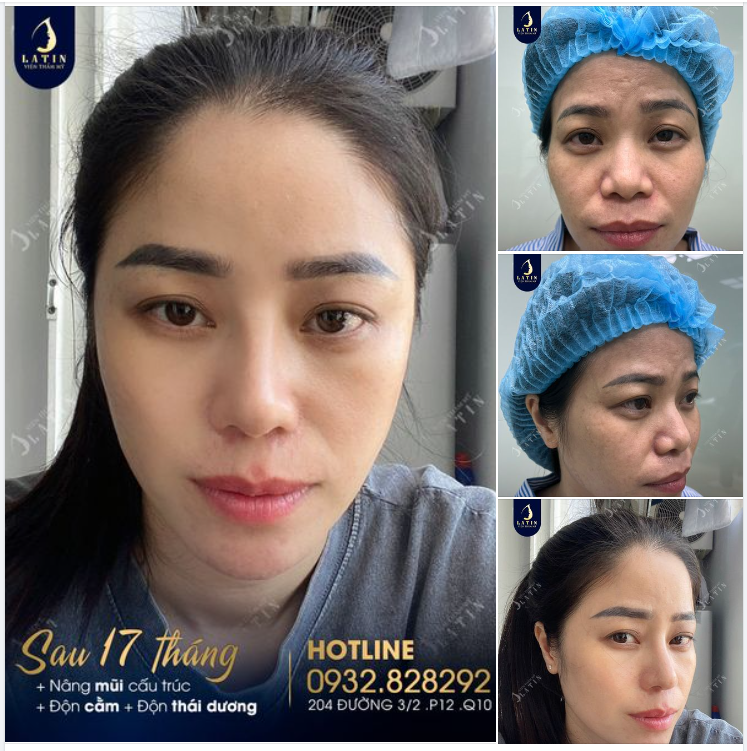 Hình ảnh 17 Tháng cho COMBO: Nâng mũi cấu trúc. Độn cằm sụn Mỹ. Độn thái dương sụn Mỹ