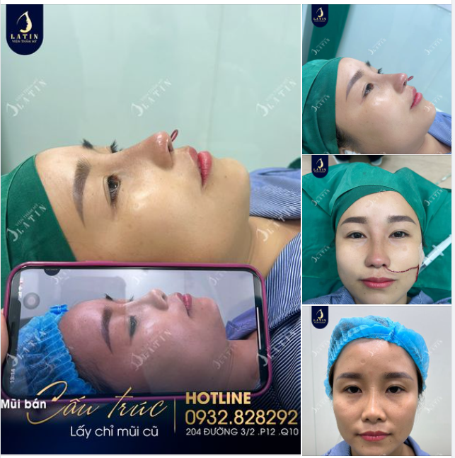 Chị gái đã từng nâng mũi chỉ. Nhưng sau một thời gian thì dáng mũi biến đổi, đầu mũi co rút.