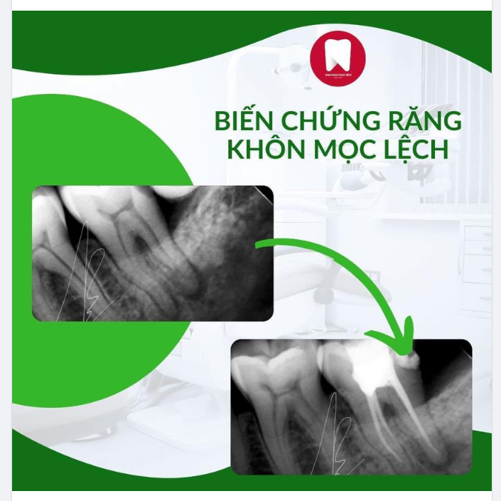 RĂNG KHÔN MỌC LỆCH KHÔNG NHỒ SỚM SẼ GÂY RA HẬU QUẢ KHÔN LƯỜNG