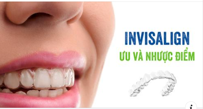 Niềng Răng Bằng Invisalign So Với Niềng Răng Truyền Thống