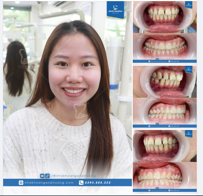 Khắc phục răng thưa, hô chỉ sau hơn 1 năm niềng