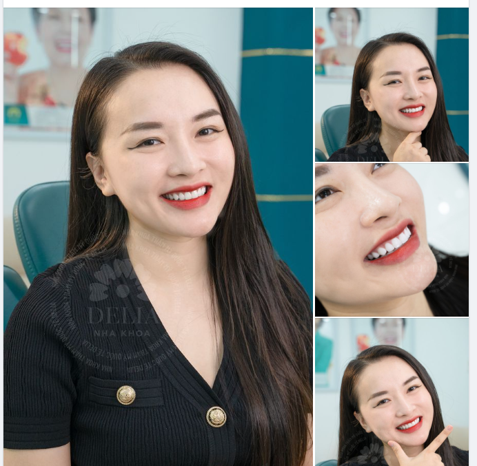 Khách hàng Huyền Trang khoe nụ cười rạng rỡ sau 3 năm làm răng sứ tại Nha khoa Delia