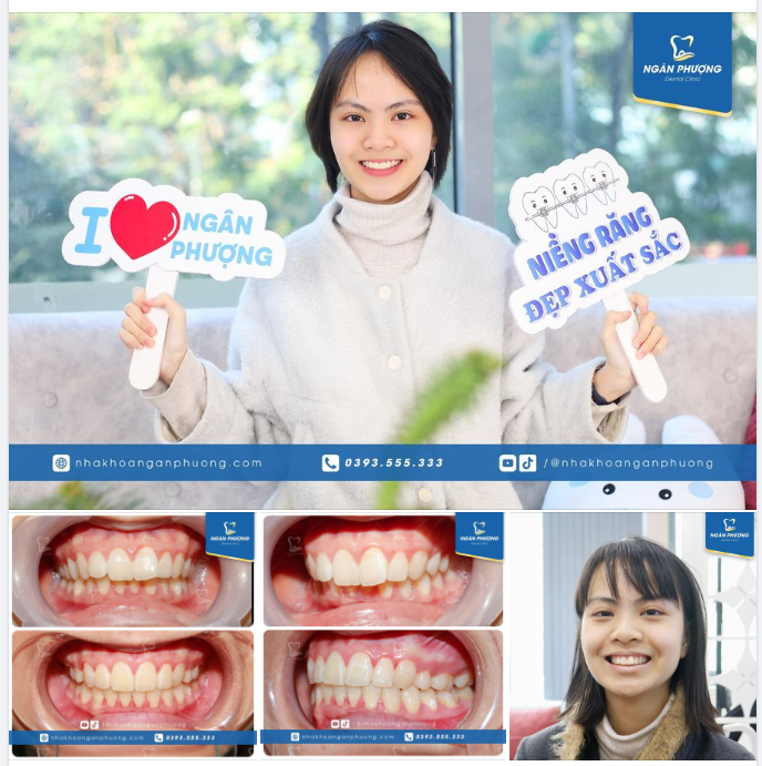 Tháo niềng đón Tết, trọn niềm vui