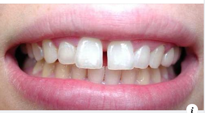 Răng cửa to và dài – Giải pháp khắc phục nhanh chóng và đẹp nhất