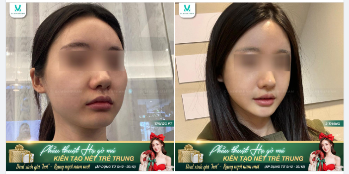 Gò má cao khiến gương mặt có phần “dữ tướng”, làm mất đi nét đẹp xinh duyên của người phụ nữ Á Đông. Vậy làm cách nào để cải thiện khuyết điểm này??