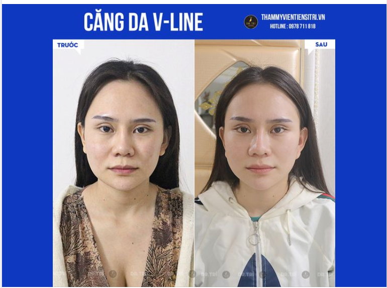 Căng da V-line - Hồi sinh tuổi trẻ. Kỹ Thuật Đính Da Không Tạo Lực