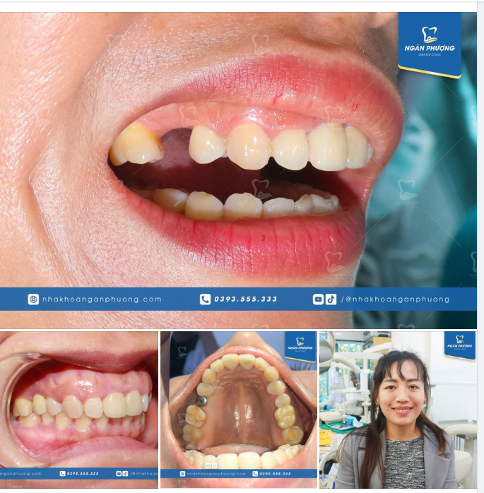 Nghe mấy bài hát là trụ implant đã được cắm xong rồi
