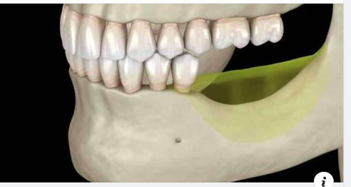 Người bị mất răng có niềng răng được không