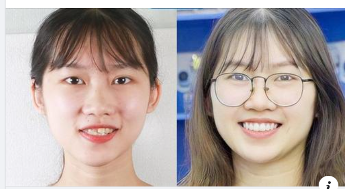 TRÍ TUỆ NHÂN TẠO - "VŨ KHÍ BÍ MẬT" ĐẢM BẢO NIỀNG RĂNG AN TOÀN GẤP 10 LẦN PHƯƠNG PHÁP TRUYỀN THỐNG