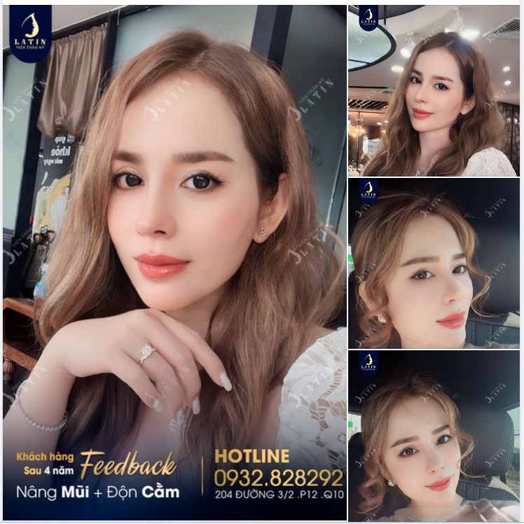 Nhan sắc đỉnh cao sau 4 năm Nâng mũi - Độn cằm
