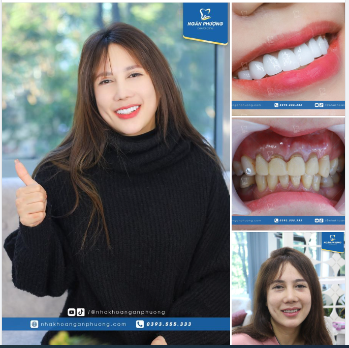 "Răng sứ cũng có răng nọ răng kia" - Chị Thanh Nguyệt tâm sự sau khi có được nụ cười và hàm răng ưng ý.