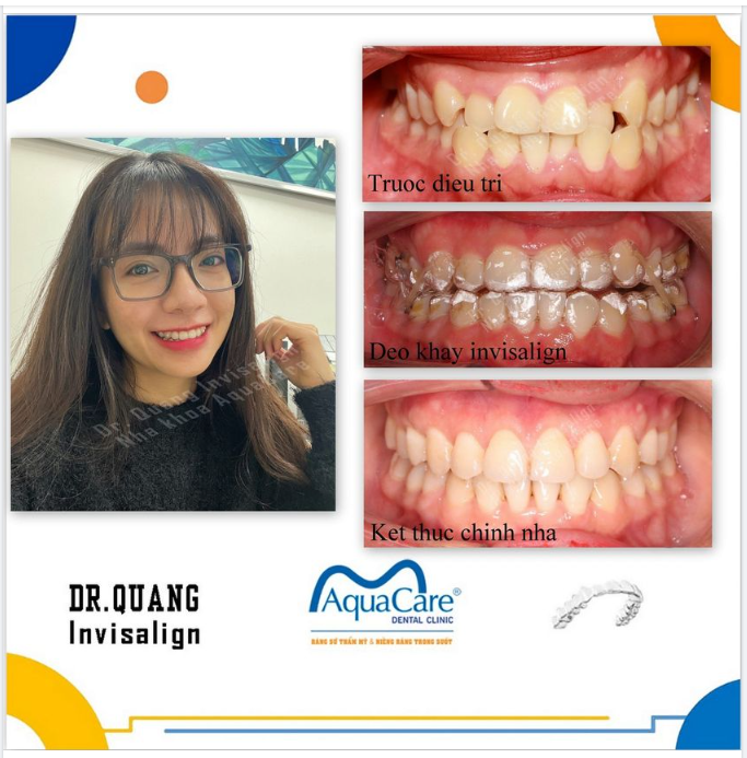 BẠN ĐÃ THAY ĐỔI NHƯ THẾ NÀO KHI NIỀNG RĂNG TẠI AQUACARE ?