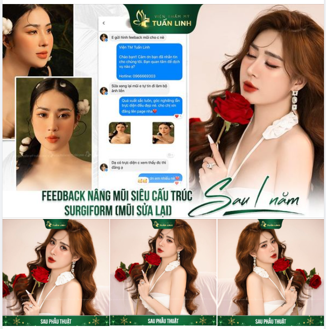 Tại sao nhiều người chọn nâng mũi cận Tết ?
