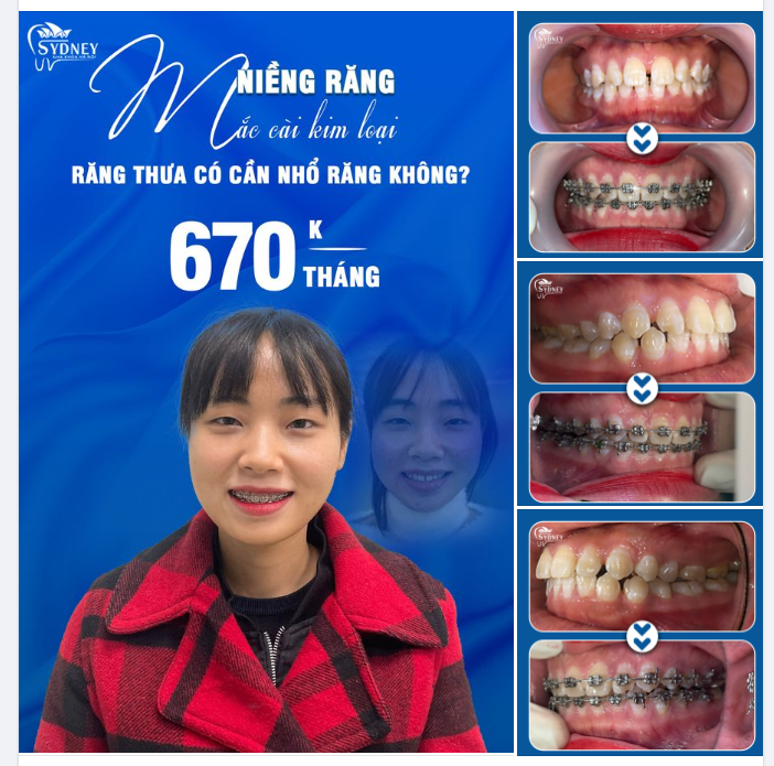 NIỀNG RĂNG THƯA CÓ CẦN NHỔ RĂNG KHÔNG?