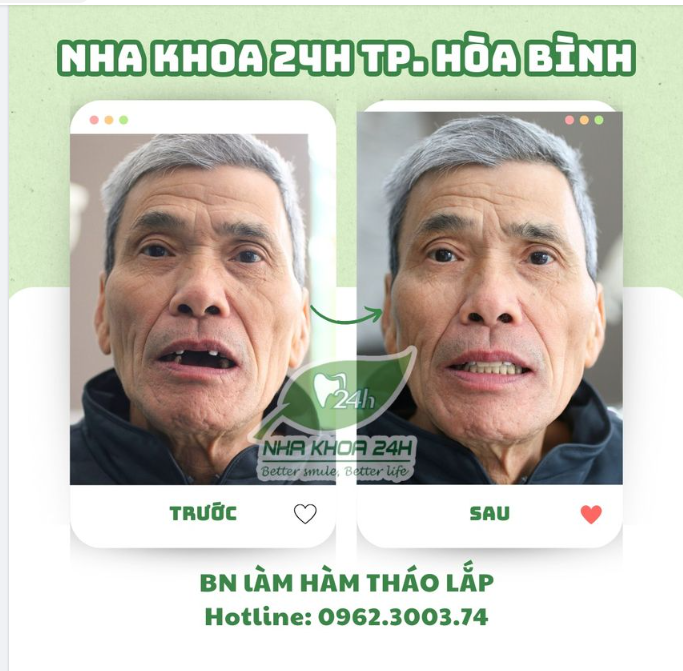 HÀM THÁO LẮP - GIẢI PHÁP CHO KHÁCH HÀNG KHÔNG ĐỦ SỨC KHỎE CẤY GHÉP IMPLANT