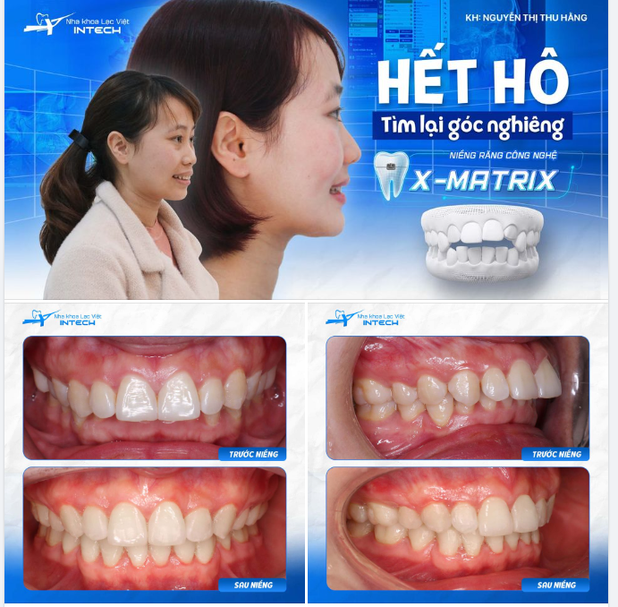31 TUỔI MỚI NIỀNG RĂNG, CÔ GÁI NHẬN KẾT QUẢ MỸ MÃN!