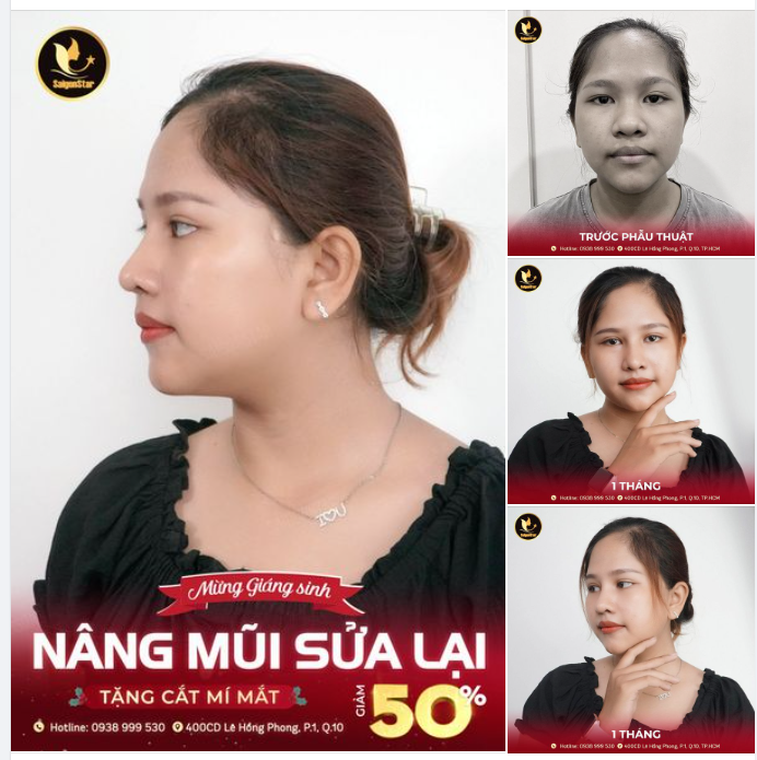 MỪNG GIÁNG SINH – RINH ƯU ĐÃI NÂNG MŨI SỬA LẠI GIẢM 50%