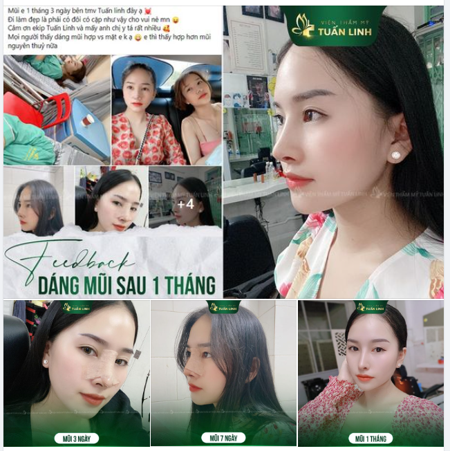 ​​​​​​​ FEEDBACK NÂNG MŨI SAU 1 THÁNG!!