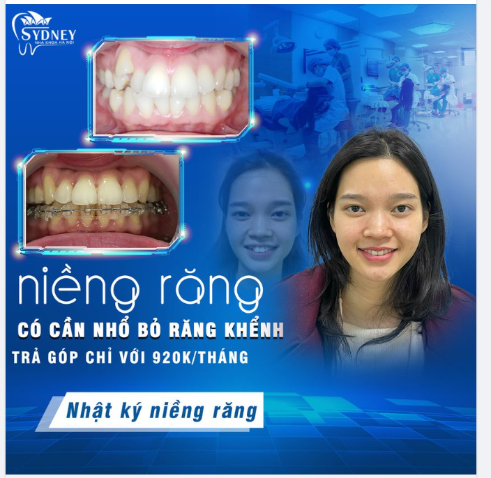 NIỀNG RĂNG CÓ PHẢI NHỔ RĂNG KHỂNH KHÔNG?