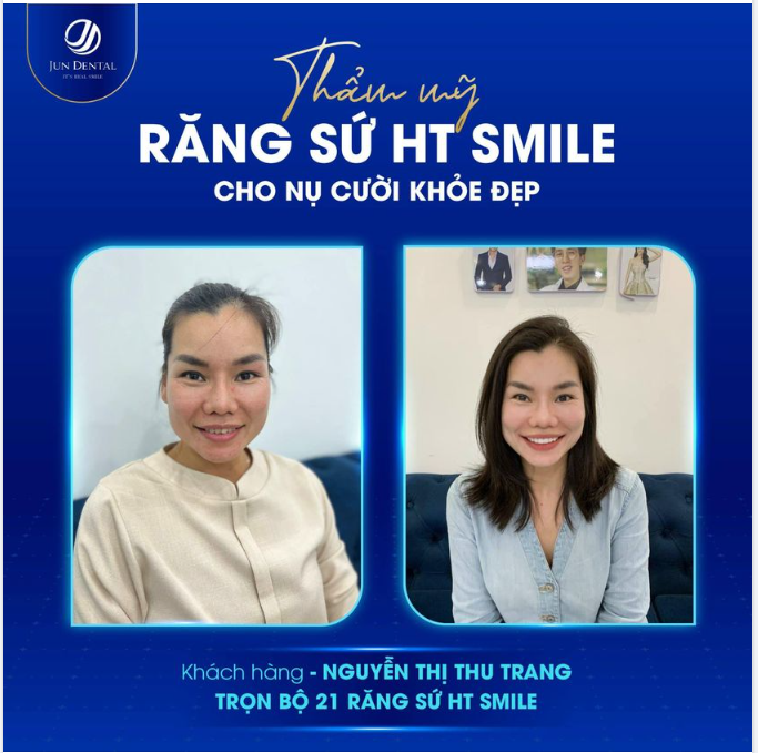THẨM MỸ RĂNG SỨ HT SMILE CHO NỤ CƯỜI KHỎE ĐẸP