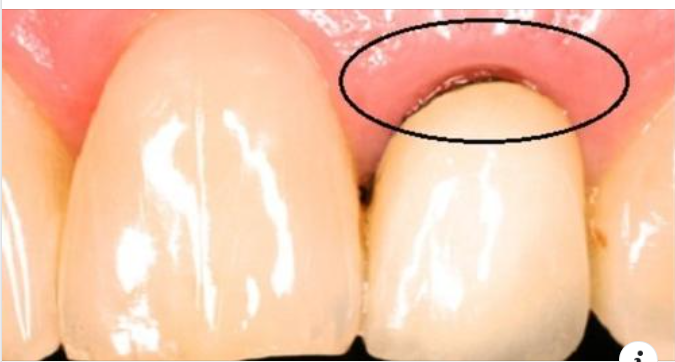 Các dấu hiệu răng sứ bị hở