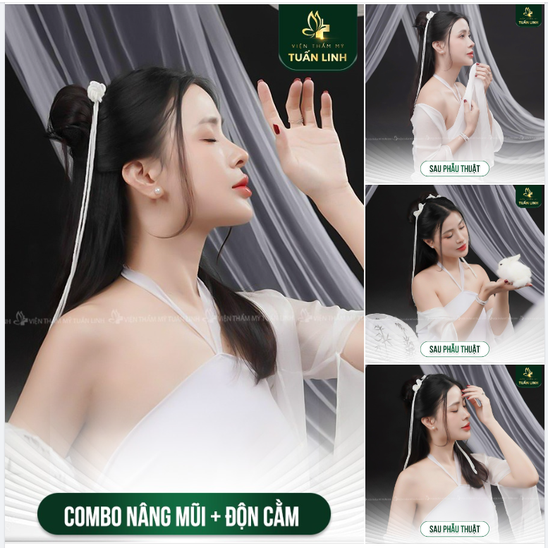 Nâng mũi + Độn cằm = Combo cho Tết này đẹp rạng ngời!!