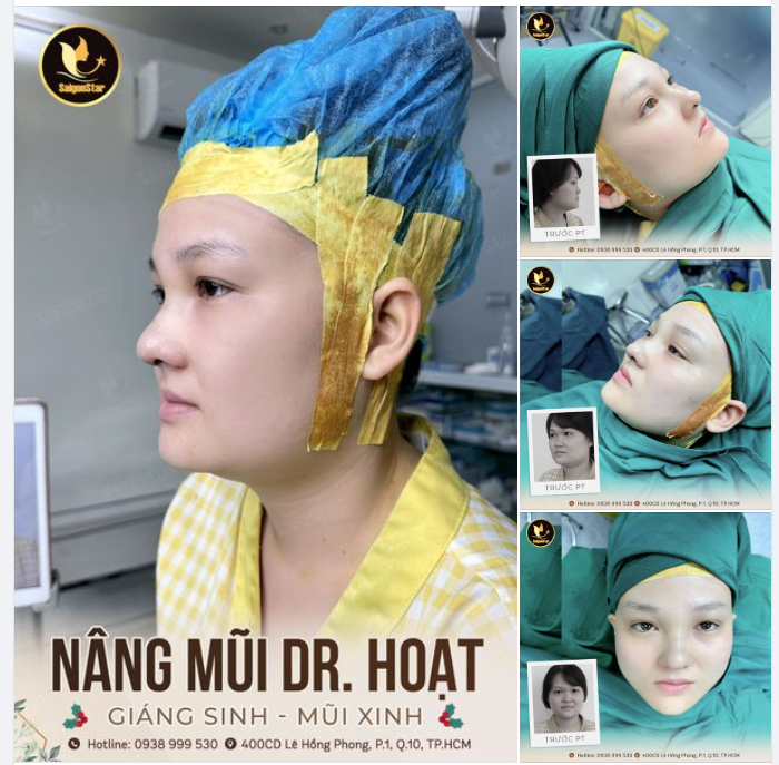 NÂNG MŨI DR. HOẠT GIÁNG SINH – MŨI XINH