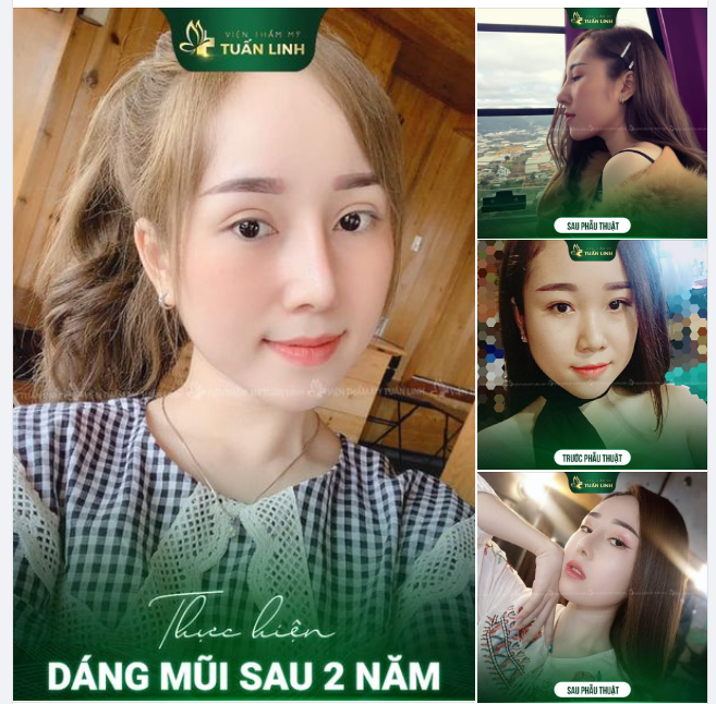 CẢI THIỆN DÁNG MŨI NÂNG TẦM NHAN SẮC!!