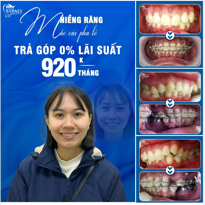 RĂNG KHẤP KHỂNH THAY ĐỔI RÕ RỆT CHỈ SAU 6 THÁNG