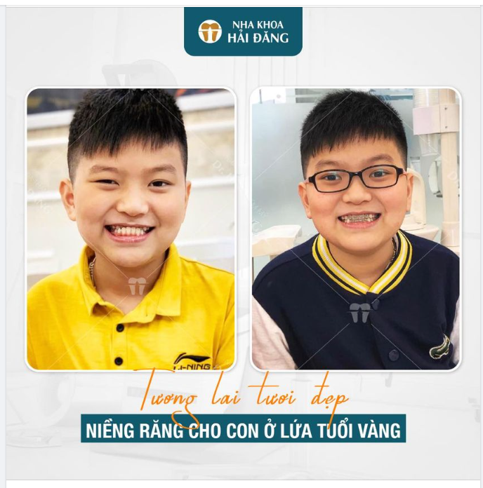 ĐỘ TUỔI VÀNG" ĐỂ NIỀNG RĂNG CHO BÉ!