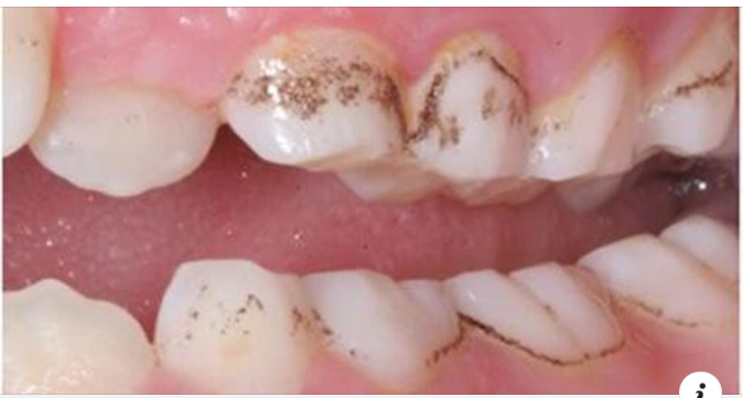 Nguyên nhân hình thành cao răng và mảng bám đen trên răng