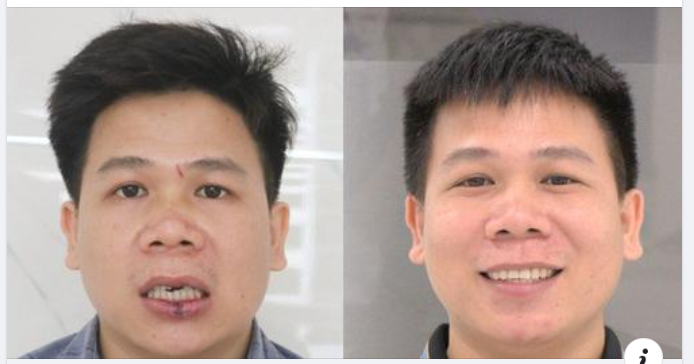 BÍ QUYẾT THÀNH CÔNG CỦA CÔNG NGHỆ TRỒNG RĂNG IMPLANT DCT