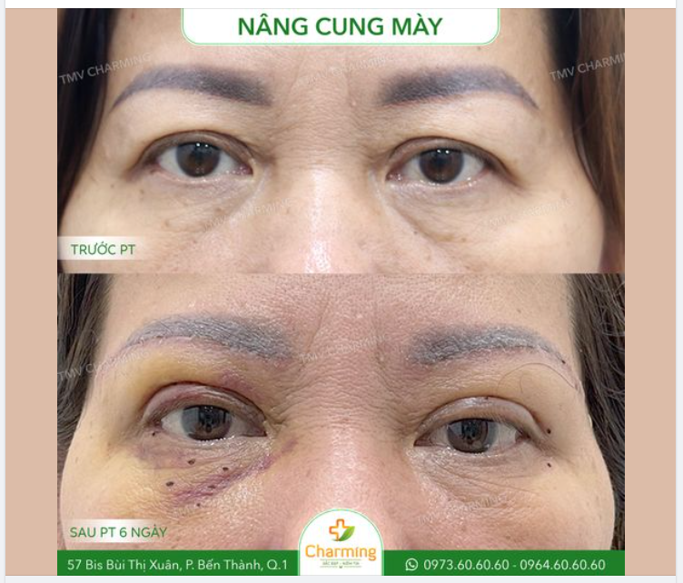 Nhìn vào ảnh chiếc cung mày này, bạn hãy thử đoán xem lý do nào khiến đôi cung mày này cần phải được nâng?