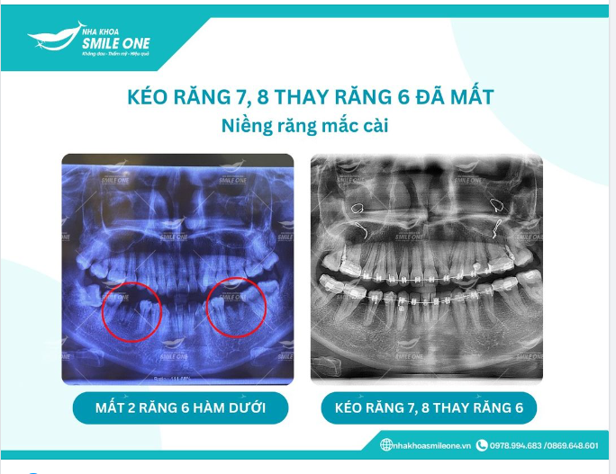 KÉO RĂNG 7, 8 THAY RĂNG 6 ĐÃ MẤT CHỈ CÒN CHÂN RĂNG
