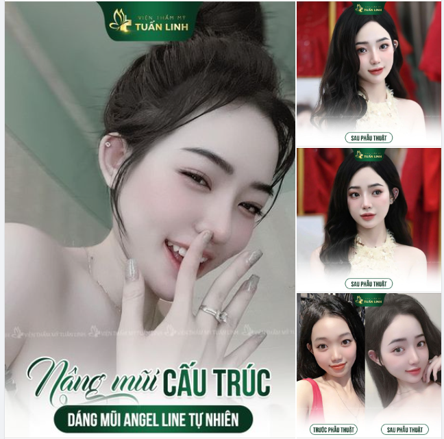 Cải thiện dáng mũi cao tự nhiên hài hòa theo yêu cầu của em khách và đây là kết quả sau nâng mũi tại Tuấn Linh ạ.