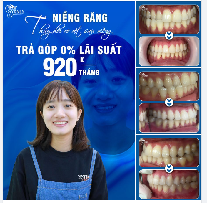 THÁO NIỀNG RĂNG LÃI CẢ SỰ TỰ TIN
