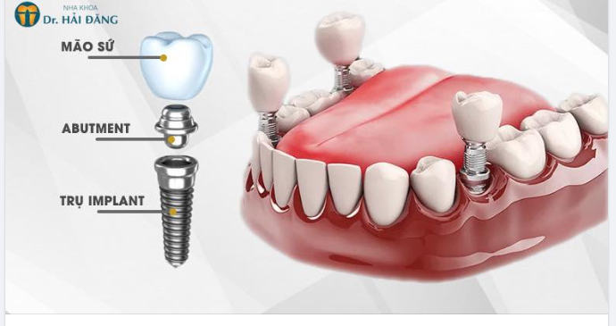 ĐỐI TƯỢNG NÊN THỰC HIỆN TRỒNG RĂNG IMPALNT