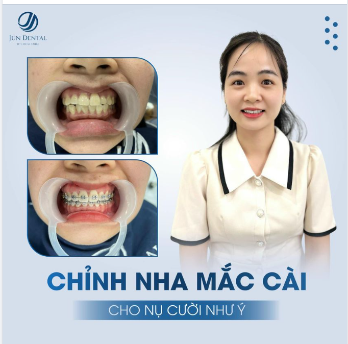 CHỈNH NHA MẮC CÀI CHO NỤ CƯỜI NHƯ Ý CÙNG JUN DENTAL