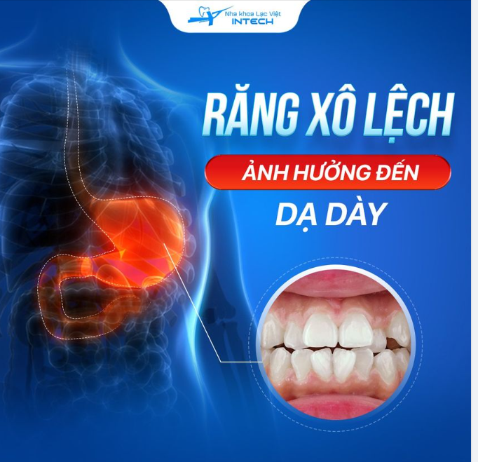 CẢNH BÁO NGUY CƠ MẮC BỆNH DẠ DÀY DO RĂNG XÔ LỆCH
