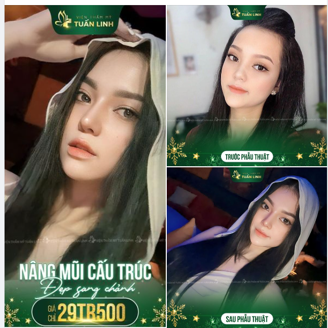 Hơn cả nâng mũi đẹp chơi TẾT này chính là nâng mũi Đẹp trọn đời Chọn NÂNG MŨI CẤU TRÚC SIÊU XỊN XÒ CHỈ VỚI 29TR500!!