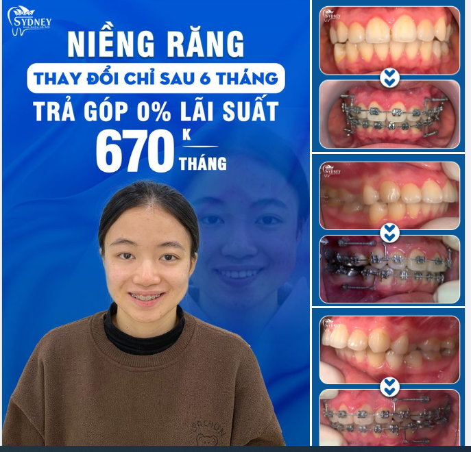 NIỀNG RĂNG GIẢM HÔ, CẢI THIỆN KHẤP KHỂNH CHỈ SAU 6 THÁNG