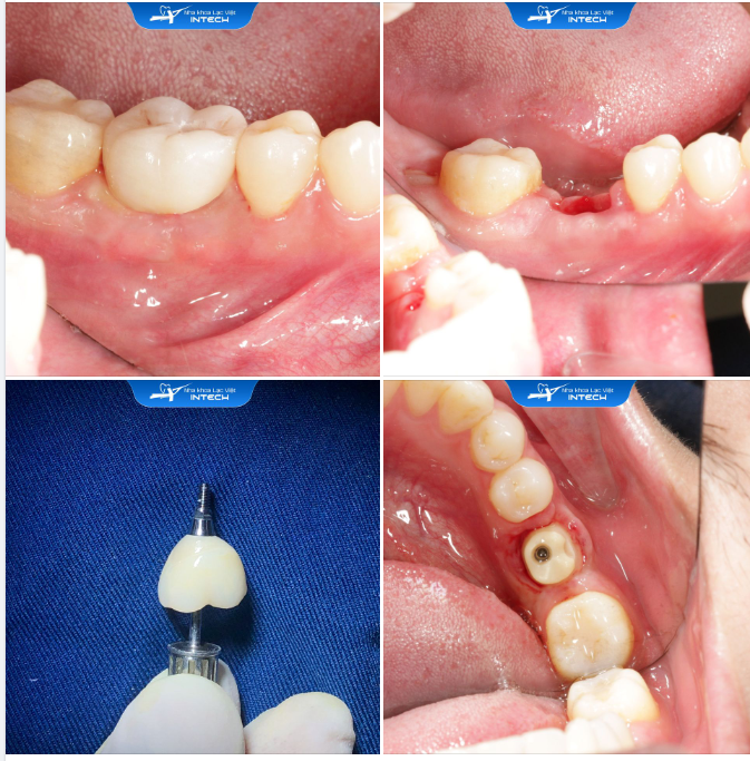 THẾ NÀO ĐƯỢC GỌI LÀ MỘT CHIẾC RĂNG IMPLANT TỐT?