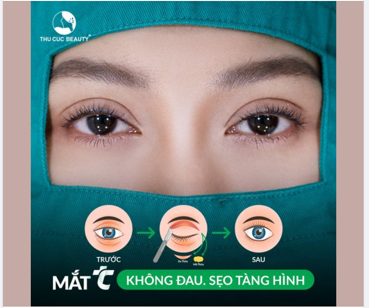 15P xóa sổ mí lót, da thừa, mí phụ... Chọn mắt TC